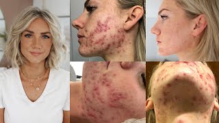 How I Cured My Adult Hormonal Cystic Acne Naturally (no accutane)