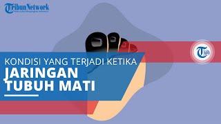 Gangrene, Suatu Kondisi yang Terjadi ketika Jaringan Tubuh Mati