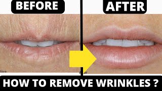 HOW TO GET RID OF WRINKLES AROUND THE MOUTH & SMOKER LINES