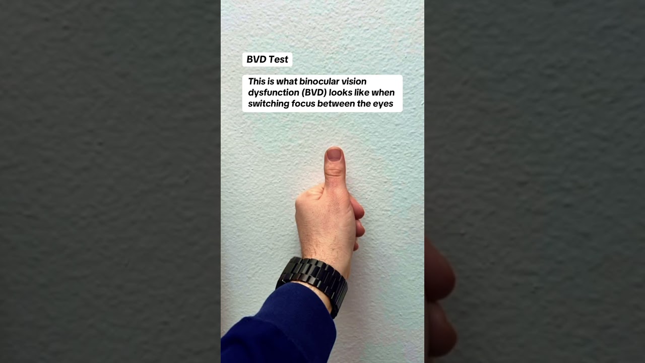 This is what binocular vision dysfunction (BVD) can look like when switching focus between the eyes!