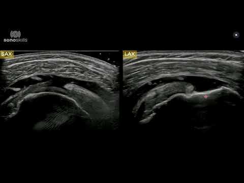 MSK Case: Ultrasound findings of a complete full-thickness tear of the supraspinatus tendon