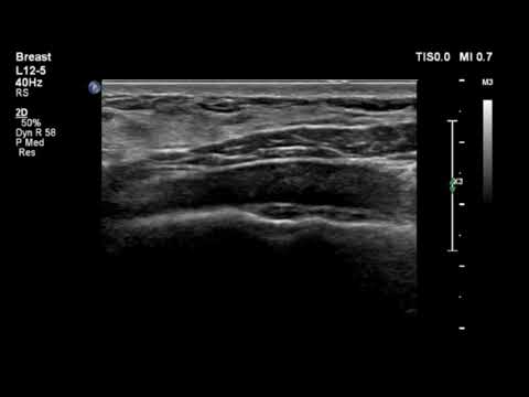 Breast Ultrasound   rib cartilage