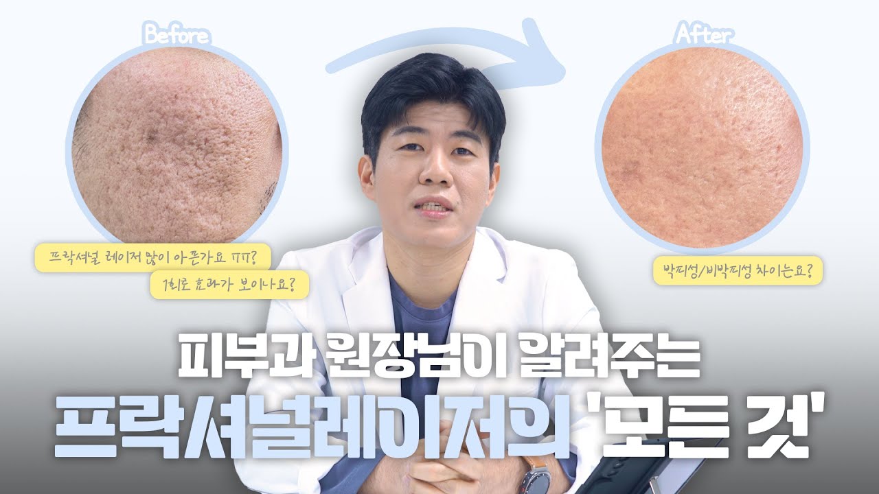 Acne Scar Fractional Laser: Why the Treatment Approach Matters