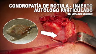 CONDROPATÍA DE RÓTULA   INJERTO AUTÓLOGO PARTICULADO