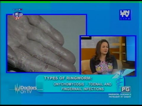 Doctors On TV: Types of skin fungus