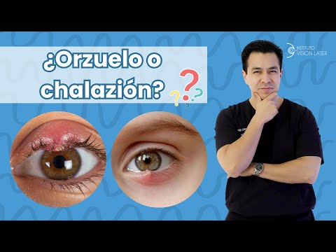 ¿Orzuelo o Chalazión?