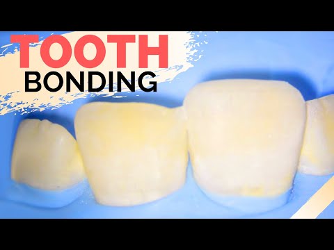Teeth Bonding Procedure | Front Tooth Filling to Repair Chipped Tooth