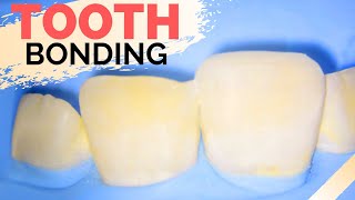 Teeth Bonding Procedure | Front Tooth Filling to Repair Chipped Tooth