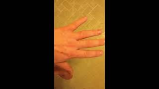 1012 allergic reaction post poison ivy