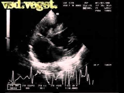 Infective Endocarditis On Ventricular Septal Defect