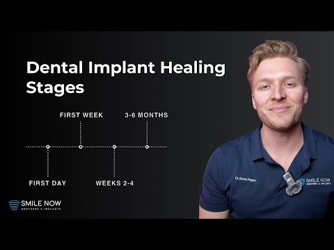 All-On-6 Dental Implant Healing Stages: Complete Dental Implant Recovery Guide