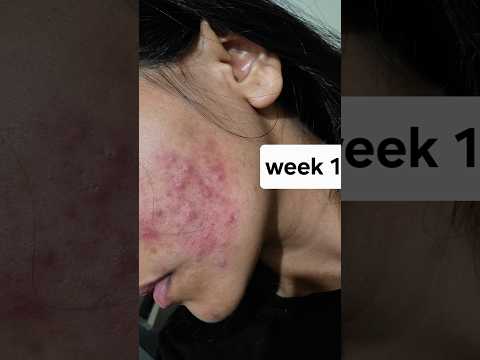 The ordinary Azelaic Acid Suspension 10% Review #theodinary  #skincareroutine #skincare #review