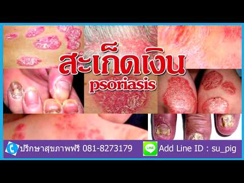 โรคสะเก็ดเงินคลินิกมอสโก การรักษาสนของโรคสะเก็ดเงิน