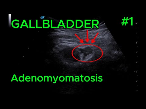 Adenomyomatosis  video preview
