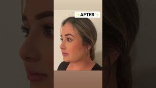 Buccal fat removal and chin liposuction combo procedure! AMAZING #beforeandafter #weightloss