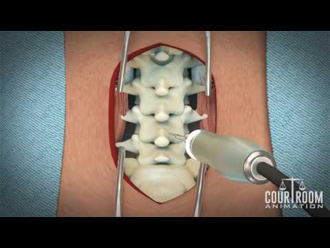 Lumbar Discectomy Surgery: Medical Animation