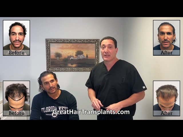 Dr. Brett Bolton Patient Rolando MaxHarvest Procedure

