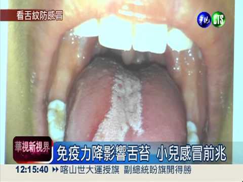 感冒前兆! 4歲女舌紋狀似"地圖"