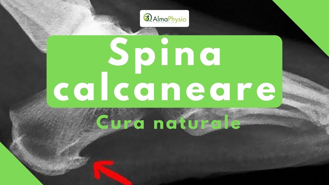 Watch Now Spina calcaneare cura naturale Spina calcaneare cura naturale