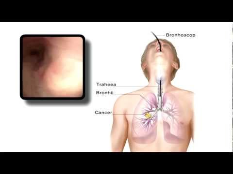 Cancer de laringe sintomas