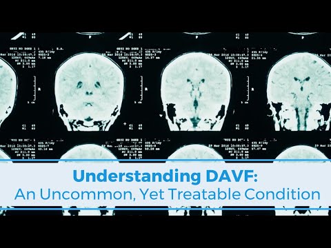 Understanding DAVF (Dural Arteriovenous Fistula): An Uncommon, Yet Treatable Brain Condition