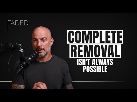 How Laser Tattoo Removal Works