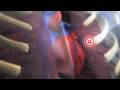 How A Clot Can Become A Pulmonary Embolism