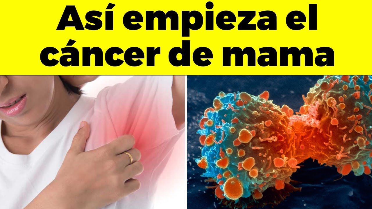 Así Empieza El Cáncer De Mama Y Nadie Tiene Cuidado - Signos Y Síntomas de Cáncer Que Debes Conocer