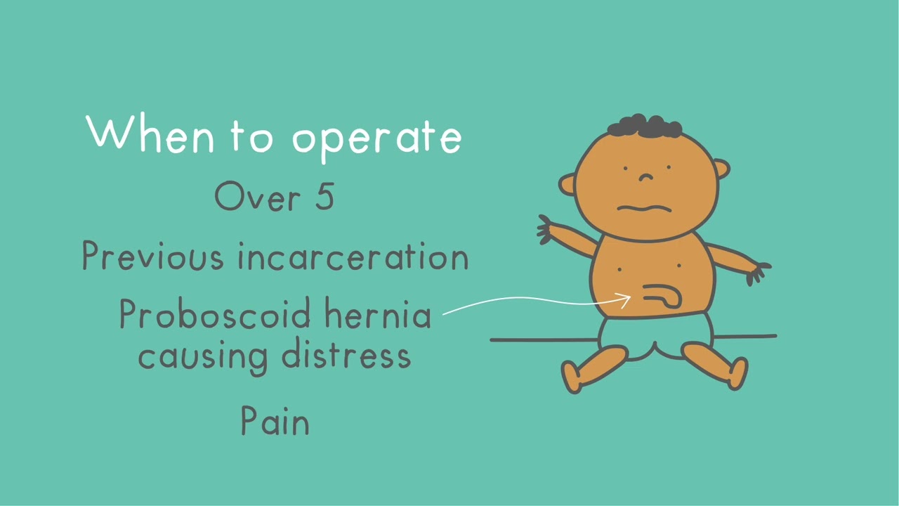 Umbilical Hernia explained in under 5 minutes