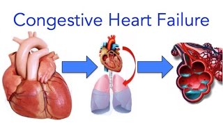 Congestive Heart Failure (CHF) Explained - MADE EASY