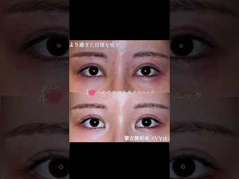 医学科 蒙古襞形成とは？目頭切開を戻す手術