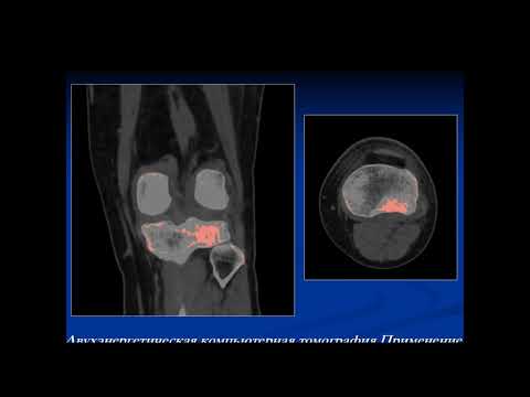 Михалюк А.В. «Двуэнергетическое сканирования в оценке отека костного мозга при КТ»