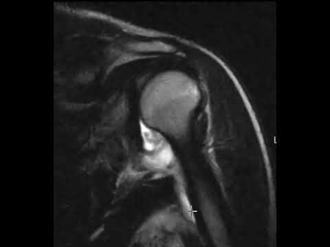 HAGL Lesion Shoulder