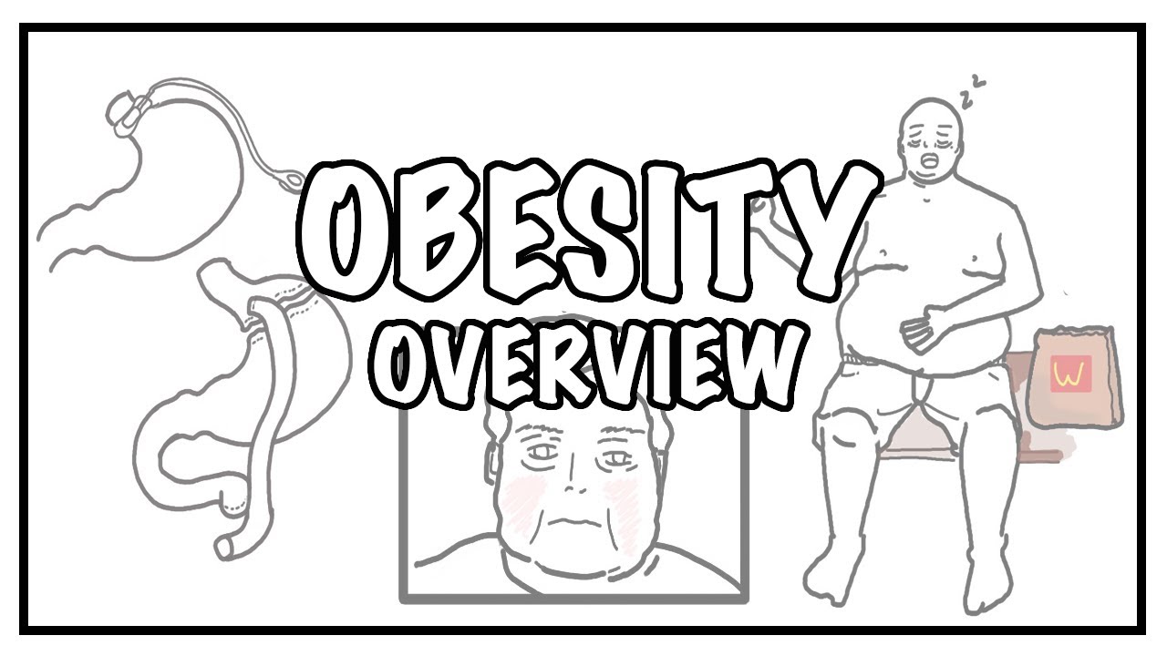 Approach to OBESITY and Weight gain - causes, risk factors, BMI, complications and treatment
