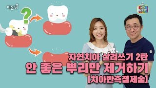 [메디텔 짤방] 자연치아 살려쓰기 2탄 - 안좋은 뿌리만 제거하기 (치아반측절제술)