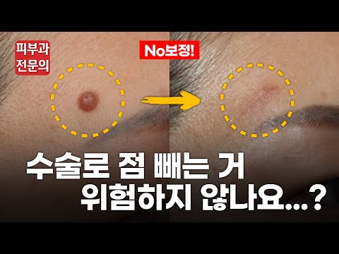 크고 깊은 점. 진피 내 모반 제대로 빼는 방법!