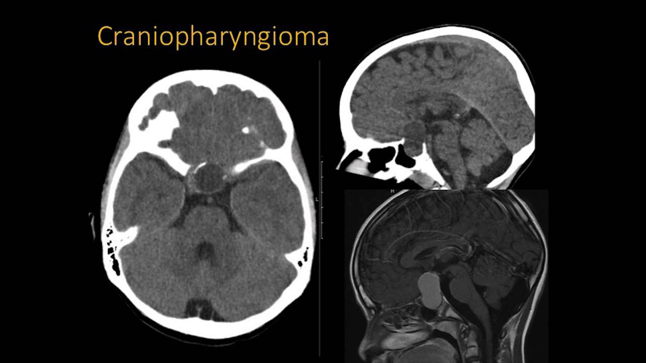 Radiological Characteristics (Hypothalamic Hamartomas) - Dr. Marcia Komlos-Kukreja