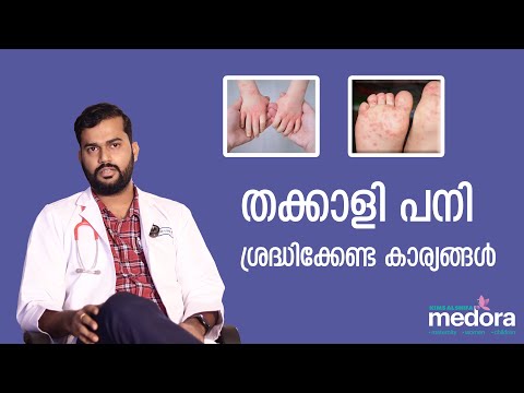 തക്കാളി പനി ശ്രെദ്ധിക്കേണ്ട കാര്യങ്ങൾ | Tomato Fever | KIMS Alshifa Perinthalmanna