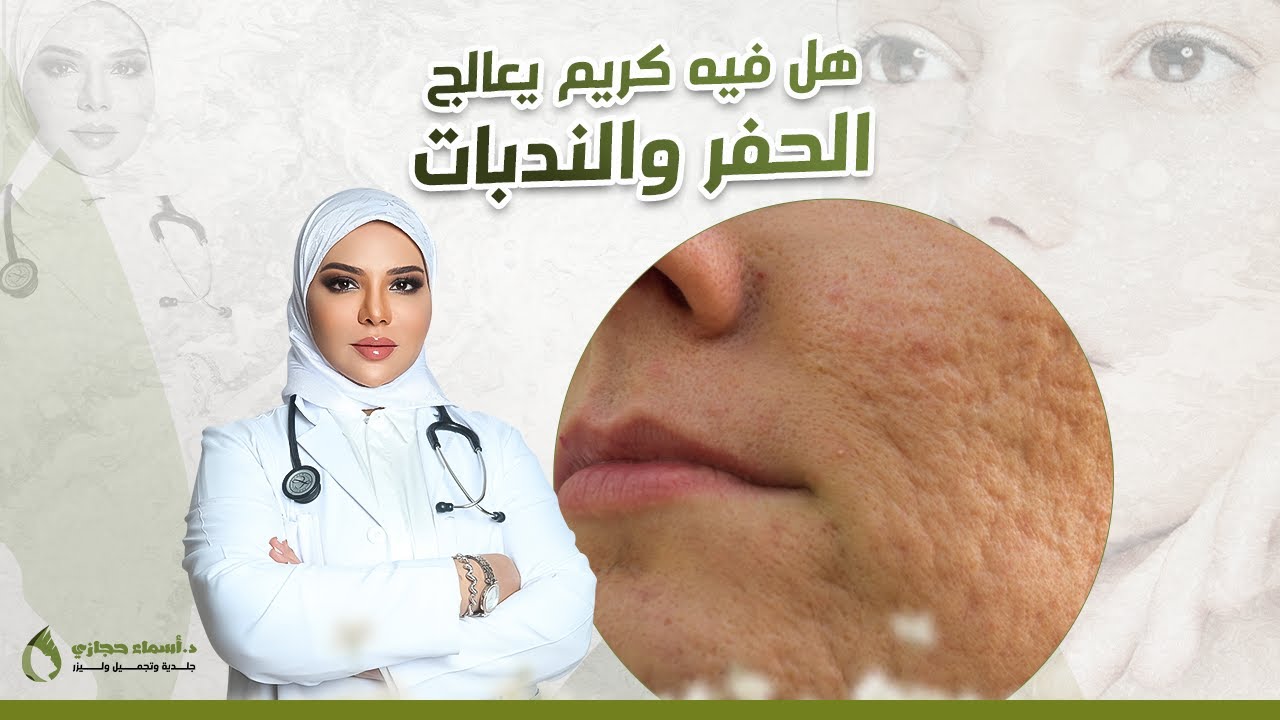 ندبات حب الشباب | لازم تشوفي الفيديو قبل ما تبدأي في العلاج | دكتور أسماء حجازي