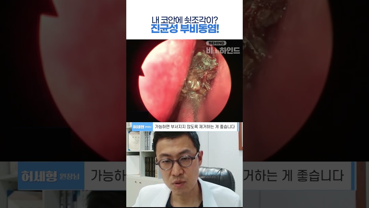 내 코안에 쇳조각이? 진균성 부비동염!