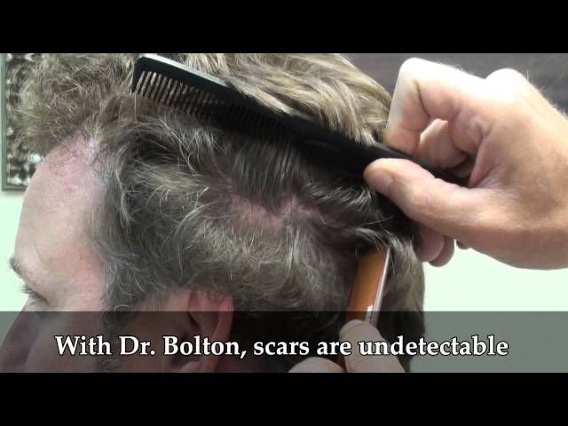 Patient 102 Undetectable Scar