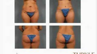 preview picture of video 'Information on Tummy Tuck Surgery  Indianapolis Indiana with Dr Janet Turkle'