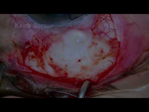 Trabeculectomy revision for hypotony maculopathy with pericardial patch and scleral flap repair