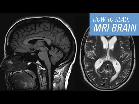 How to Read a Brain MRI: Basic Search Pattern & Sequences Explained for Beginners