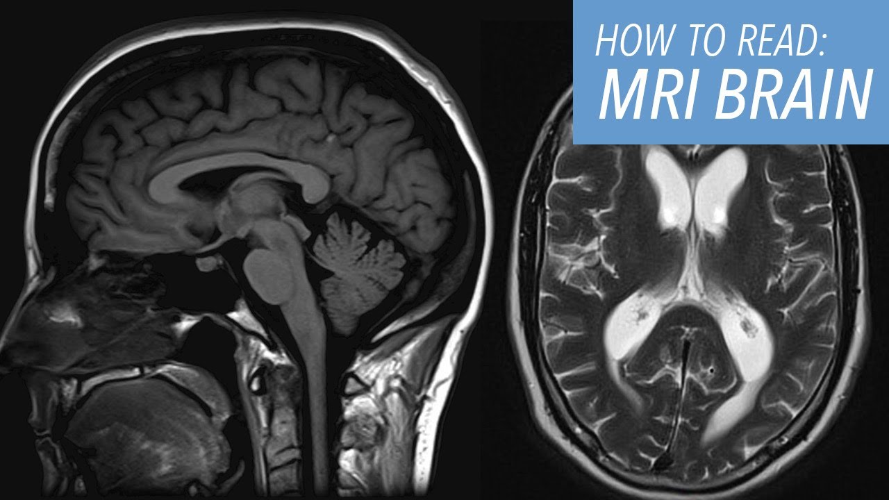 How to Read a Brain MRI: Basic Search Pattern & Sequences Explained for Beginners