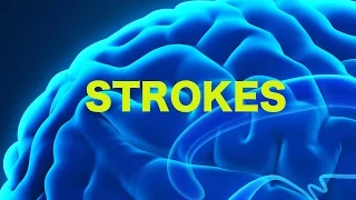 Strokes & The Rule of 4s || USMLE