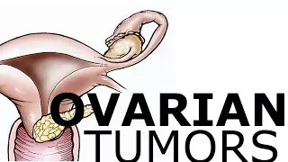 Ovarian Pathology & Tumors