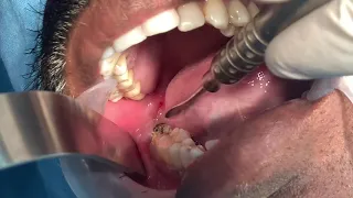 Mesioangular impacted wisdom tooth removal - Third molar extraction under local anesthesia video Mesioangular impacted wisdom tooth removal - Third molar extraction under local anesthesia video
