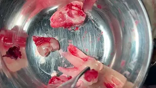 All the four wisdom teeth removal - third molar extraction oral surgery in India by Dr. Richardson All the four wisdom teeth removal - third molar extraction oral surgery in India by Dr. Richardson