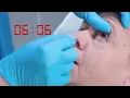 Morgan Lens - Eye Irrigation (Medi-Flow Lens) video